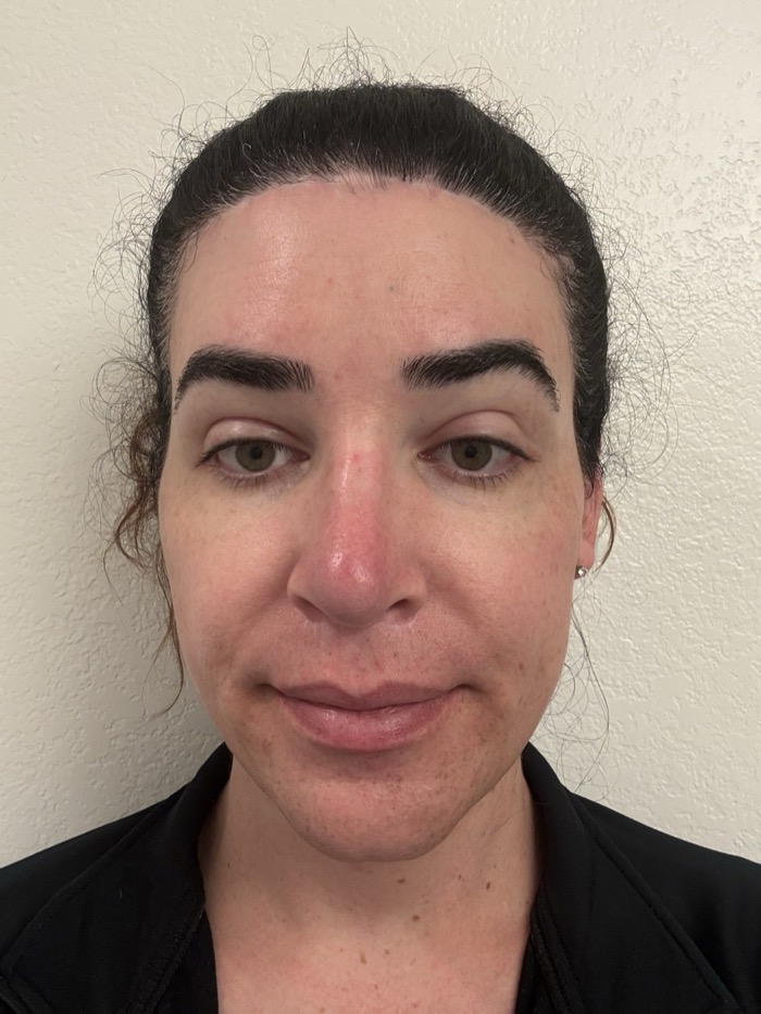 Before: bare skin after moisturizer, with visible redness across the nose, cheeks, and chin