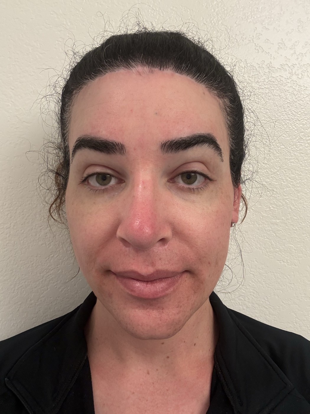 Face after applying sunscreen: skin appears slightly more even and luminous than with moisturizer alone, but the redness across the nose and cheeks remains clearly visible
